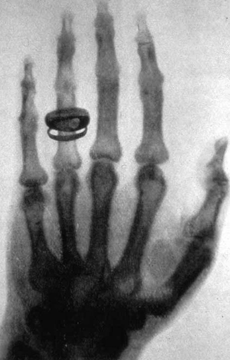Biography | Wilhelm Röntgen — He X-Rayed von Kölliker's Hand in This Auditorium